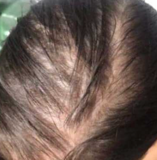 Thyroid Health and Hair Loss in Women