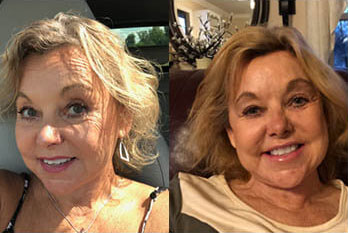 Exploring the Causes Behind Women's Hair Loss: What is Why It Happens and How to Address It