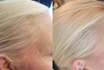 Hair Loss in Women Thinning at the Back of the Head