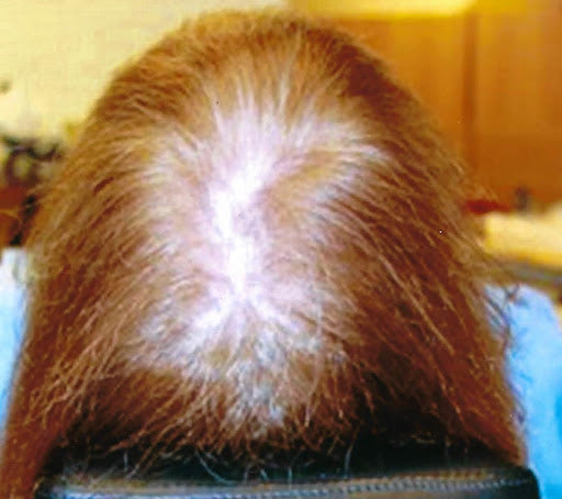 What is Stage 3 Hair Loss in Females: Causes, Symptoms, and Solutions