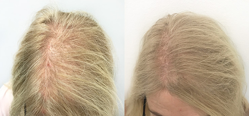 Early Signs of Hair Thinning in Women: What to Look For