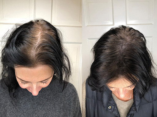 Effective Solutions for Hair Loss Treatment in Women